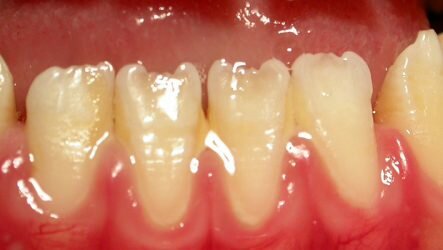Что такое некариозные поражения зубов до и после прорезывания?