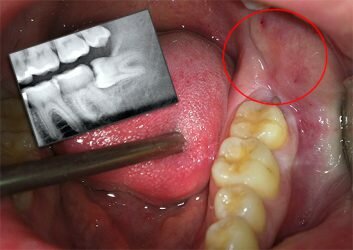 Лезет коренной зуб болит десна что делать thumbnail