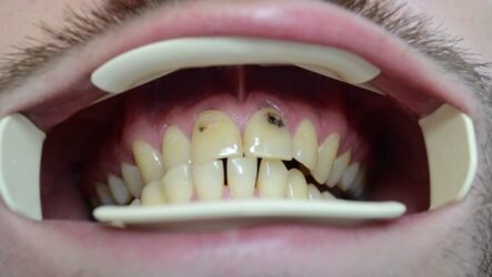 Что характерно для кариеса на передних зубах и в чем его особенность?