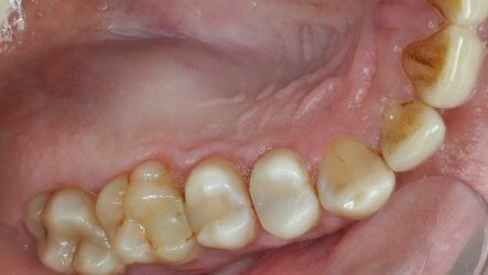 Что такое киста челюсти и как ее лечить?