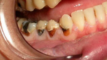 Особенности кариеса корня зуба и его лечение