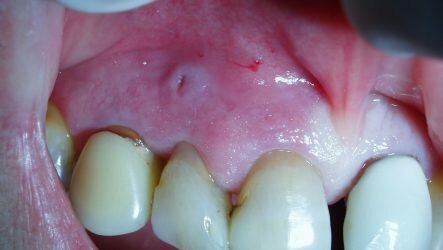 Особенности кистогранулемы зуба и рекомендации по лечению