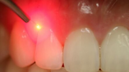 Как лечат кисту зуба лазером?