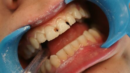 Что характерно для кариеса между зубами и почему он возникает?