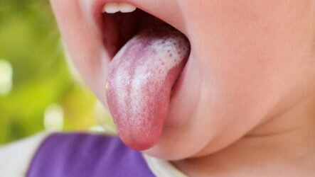 Почему возникает налет на языке у ребенка и признаками какого заболевания он может быть?