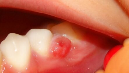 Какие могут быть последствия у кисты зуба?