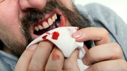 Кровотечение после удаления зуба мудрости: сколько может быть и как остановить?